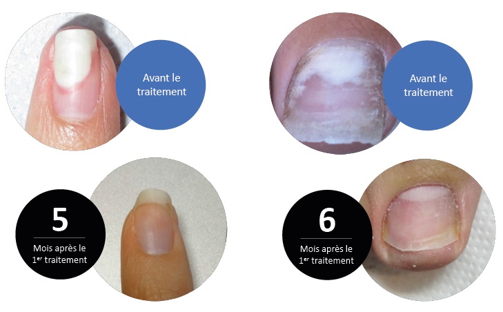 Laser de nettoyage des champignons des ongles pour onychomycose, outil  révolutionnaire à usage domestique pour les ongles des doigts et des  orteils : : Santé et Soins personnels
